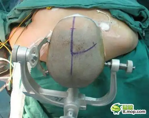 恐怖神秘开颅手术全过程组图