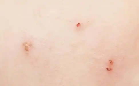 病毒性疱疹的症状表现是什么