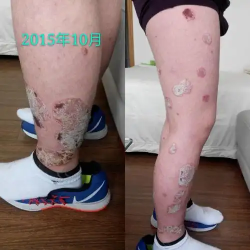 顽固性寻常型银屑病病例