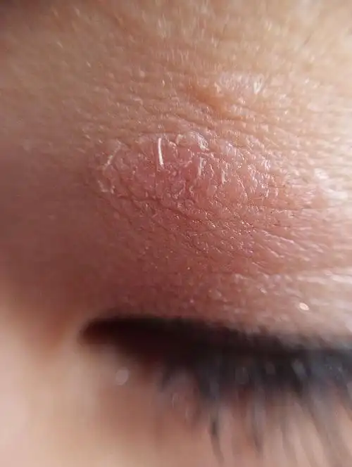 眼皮上长了一小块像掉皮的,是什么?急?