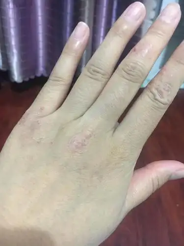 手部湿疹咋办呢