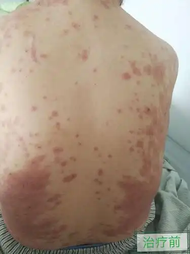多形红斑型药疹诊治1例