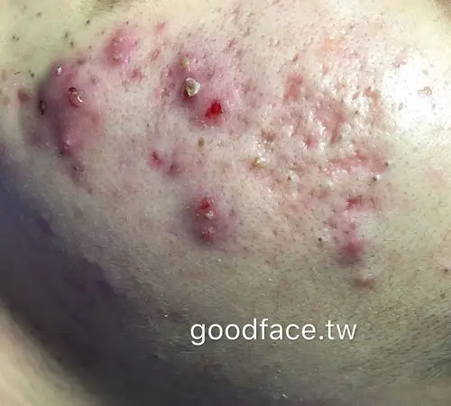 囊肿型痘痘治疗