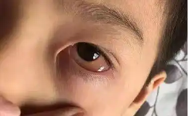 抗敏日记陈志钧医生眼睛里的鱼泡泡浅谈儿童过敏性结膜炎中的趣事一枚