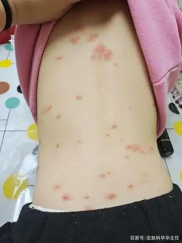 门诊案例|4岁银屑病女孩,这样用药量小效高,一个月后见效