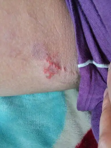 就是胯部阴囊附近大腿根部,痒,挠挠就成这样了,擦了999皮炎平,没什么