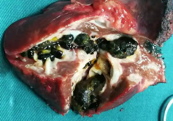 医学科普肝胆道结石防治健康讲座