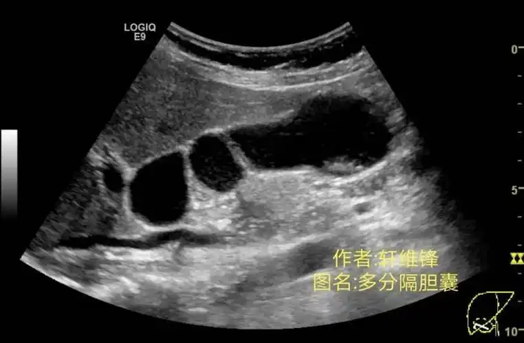 胆囊腺肌症及其它美图分享