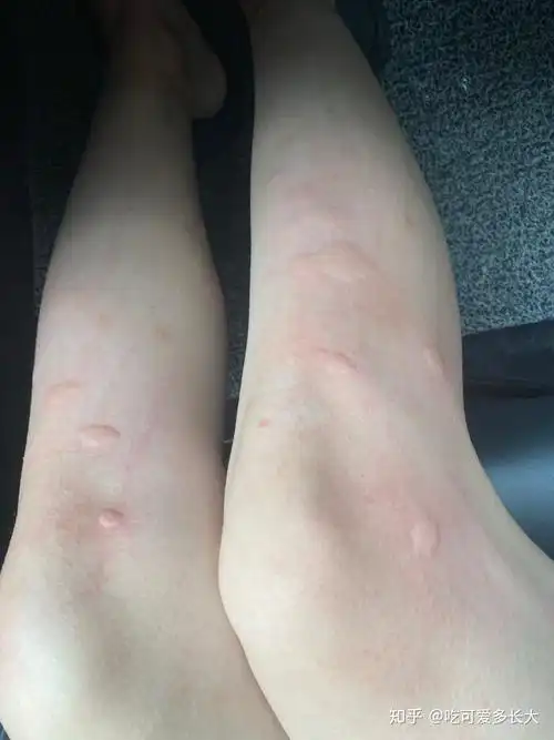 在南方,被毒蚊子咬是一种怎样的体验? - 知乎