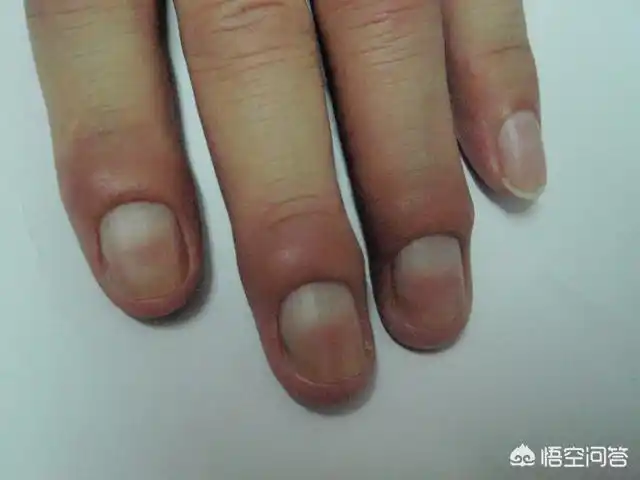 肝脏容易火大,若是肝火绵延不去,对指甲的典型影响就是指甲发红.