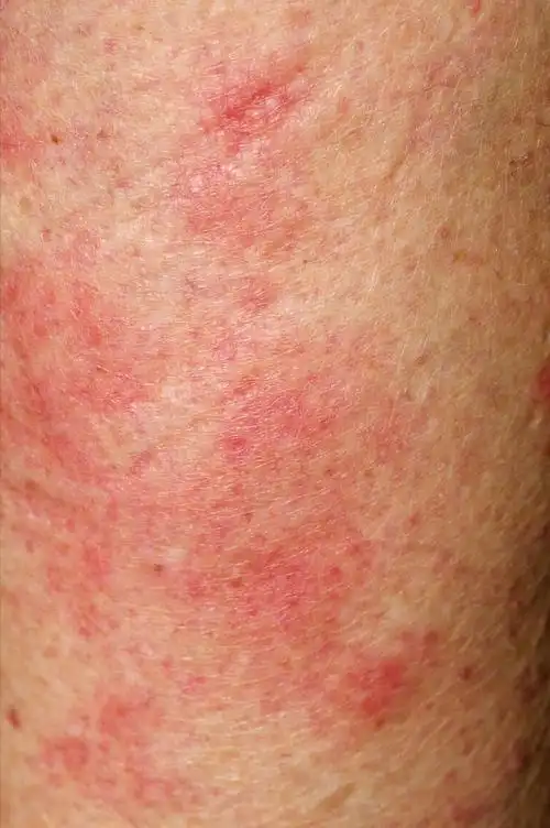 中医如何辨治荨麻疹?诊治思路是什么?