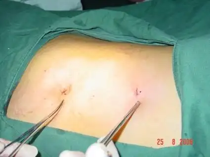 的切口,左上腹的切口是肾盂成形术的切口,切口下的疤痕是引流管的出口