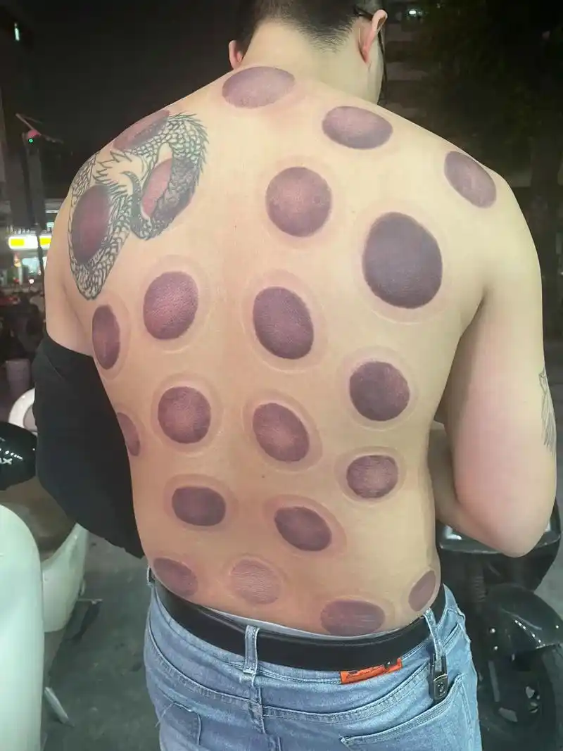 拔罐后出现紫色说明什么 这个湿气不得鸟,怪不得这几天这么难 - 兑趑