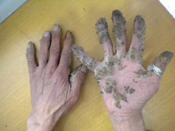 脚上长鸡眼?其实很多都诊断错了!-纪秀军主任医师-爱问医生