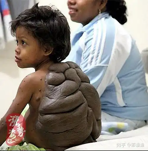 涨姿势第46弹10位恐怖的畸形人天黑后千万不要点开