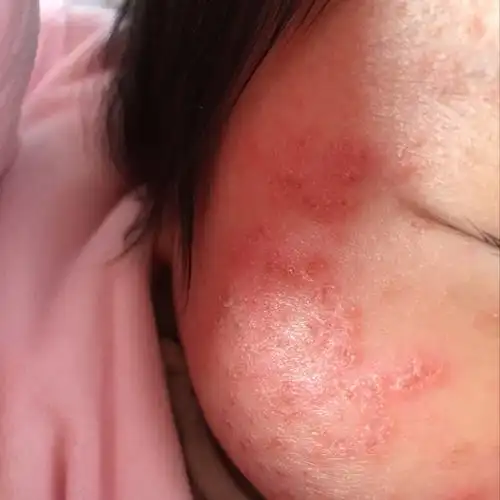 宝宝脸上湿疹怎么办 50天宝宝脸上湿疹怎么办