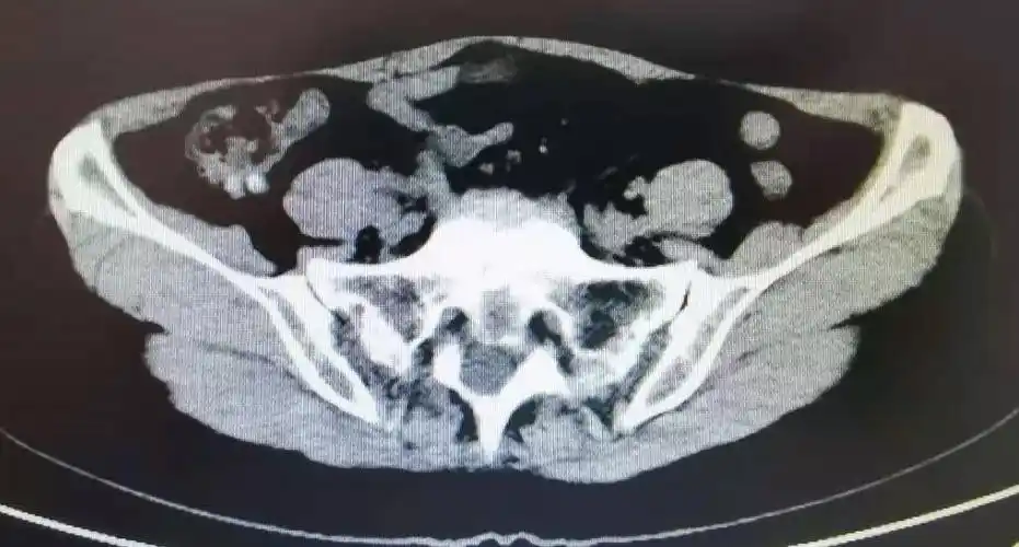 ct腹部:回盲部及升结肠多发憩室伴粪石形成,伴憩室炎.