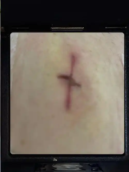 阑尾手术第八天,拆线啦