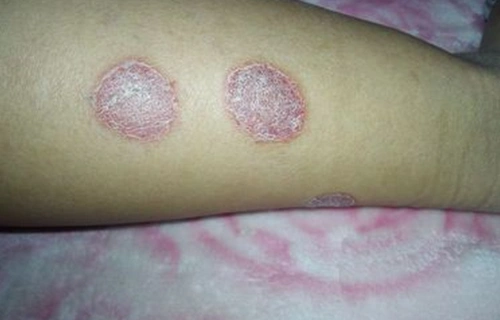 其他癣专家_其他治疗癣哪个专家好_其他治疗癣最好的专家/排行_有来