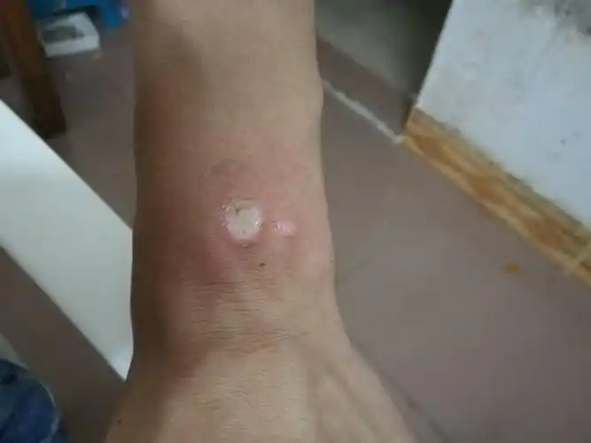 手被烟给烫了一下,以后会不会留烟疤