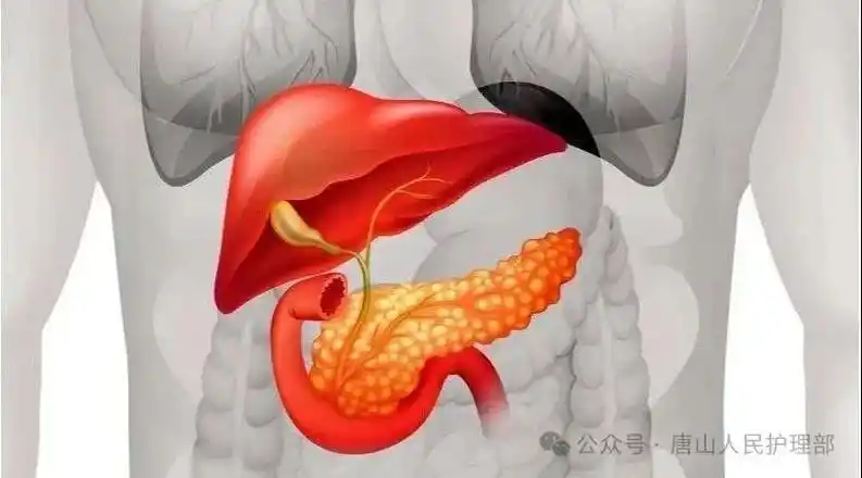 重症急性胰腺炎的健康科普