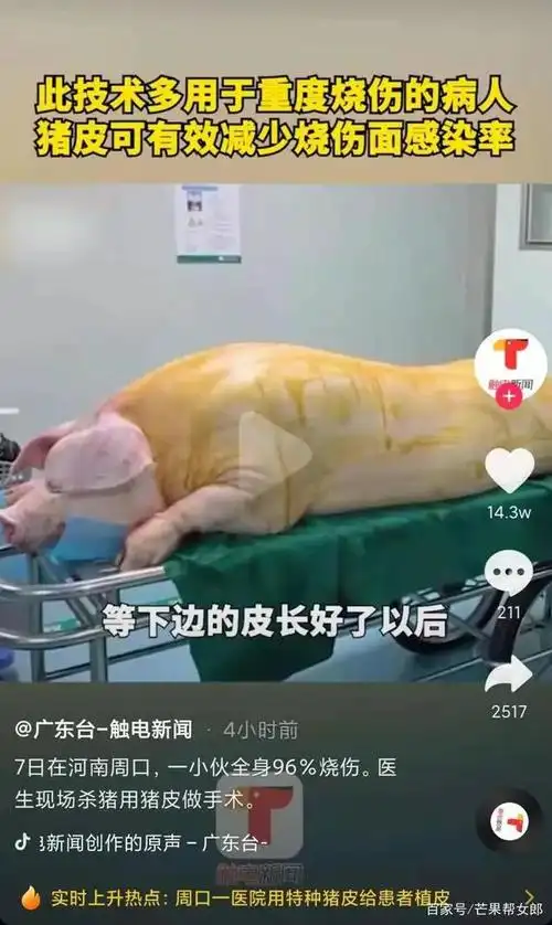 小伙全身96%烧伤,医生用猪皮植皮!