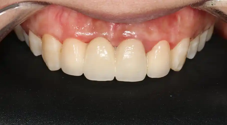 一例前牙烤瓷冠桥再修复病例