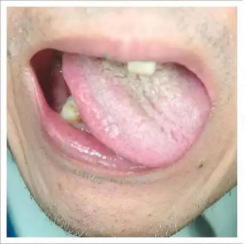 通过你的舌头,了解你的健康