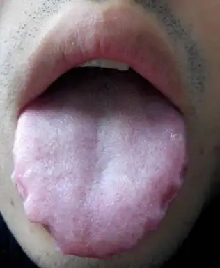 齿痕舌是怎么回事什么病呀