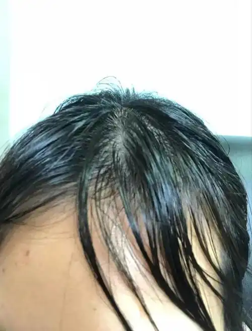 头发特别容易油头皮屑比较多每天洗头可以吗