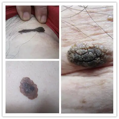 脂溢性角化症_老年斑_疾病介绍_介绍 - 好大夫在线