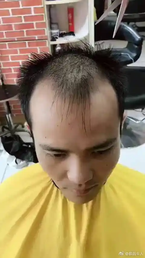 前额两边秃顶最适合的发型!转需.