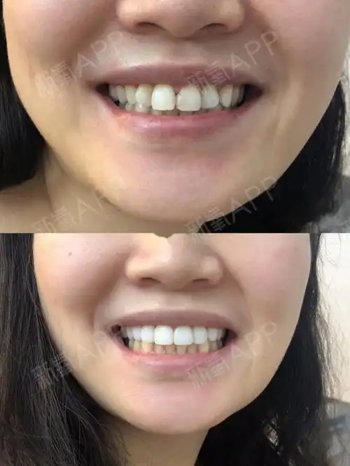 牙贴面 超瓷贴面 牙齿美白上下对比 自然白案例