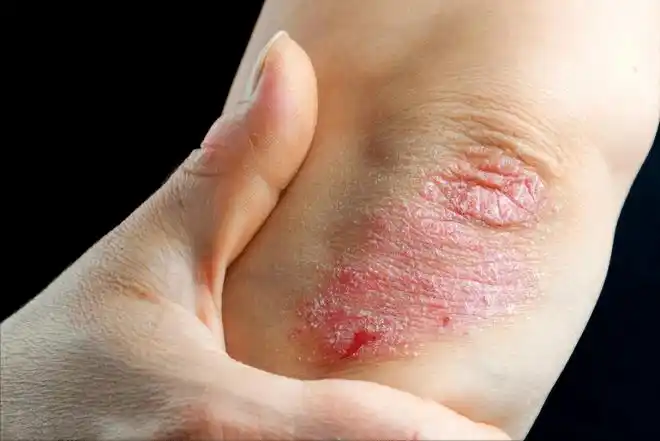 银屑病怎么治才能断根?