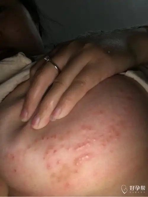 孕29周了,胸上长满了小疙瘩,痒的不行