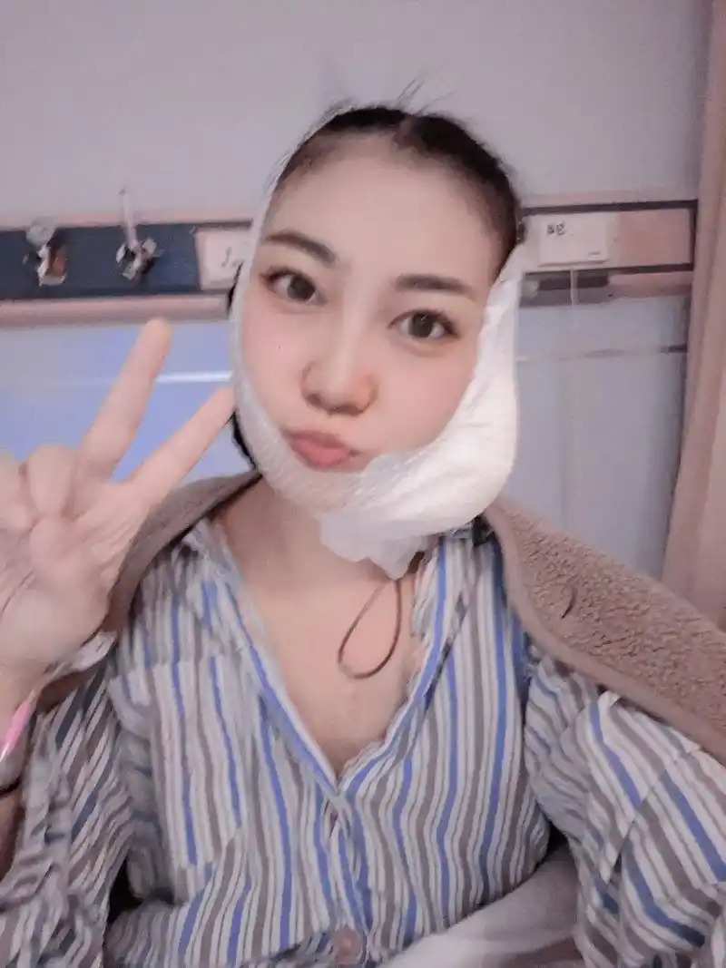 再也不见 腮腺混合瘤  再也不见 今天是拆线后的第7天,术后第22天