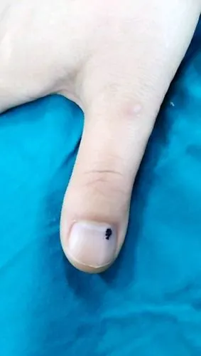 甲下血管瘤的症状表现_血管瘤_血管瘤症状 - 好大夫在线