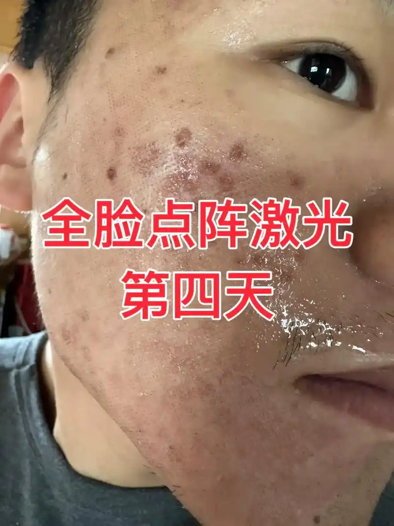 全脸点阵激光第四天