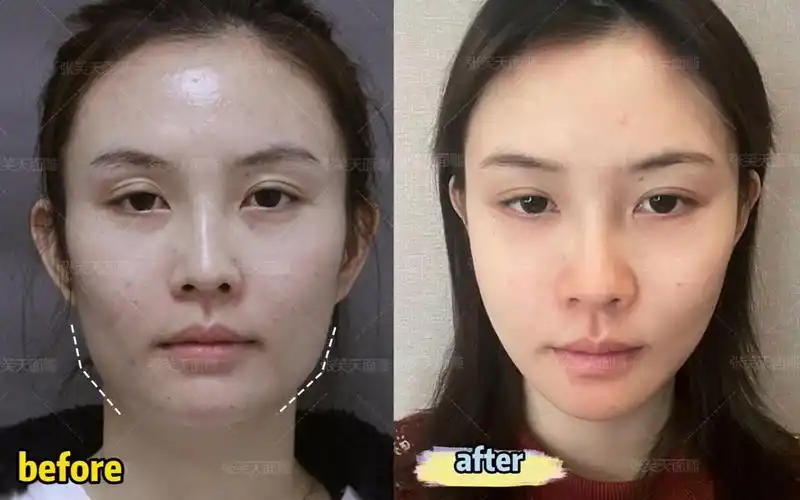 活动作品张笑天下颌角案例从方脸到瓜子脸换脸成功