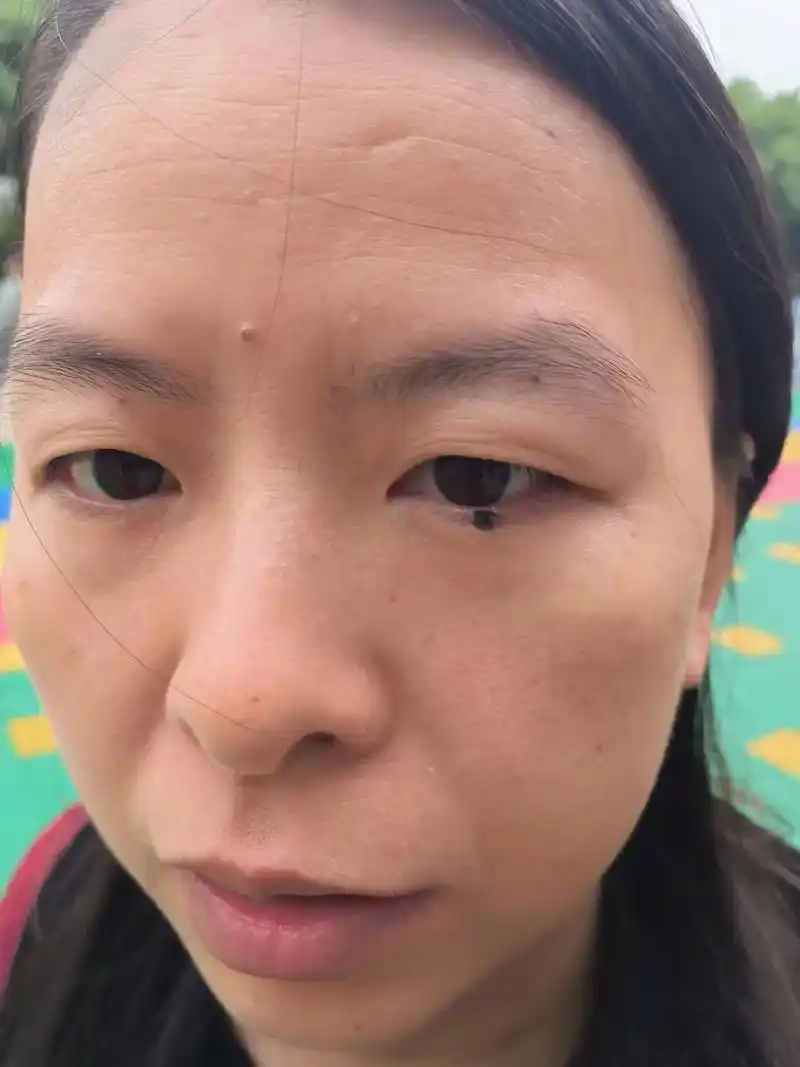 泪痣,不留疤,不留痕,有需要的联系19047942396 开 - 抖音