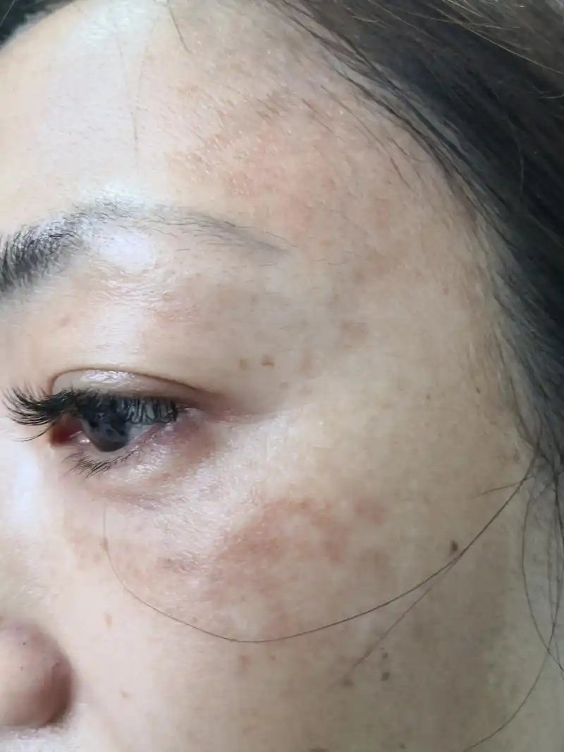 额头面颊弥漫性黄褐色斑片.