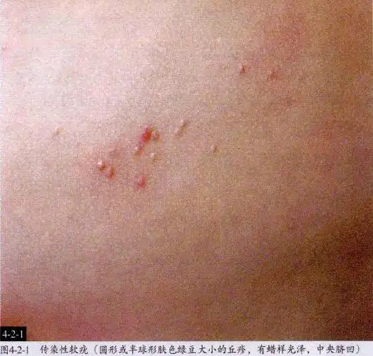 病理照片皮肤病图谱附治疗方法胆小勿入