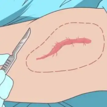 多年的旧疤痕还能去除吗?