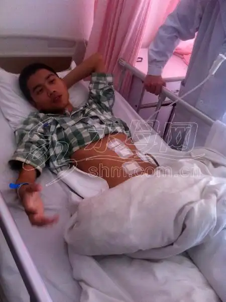 男子影院内踩空楼梯摔座椅上撞破脾脏