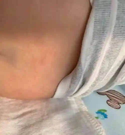 纸尿裤过敏的症状从图片上看长什么样子