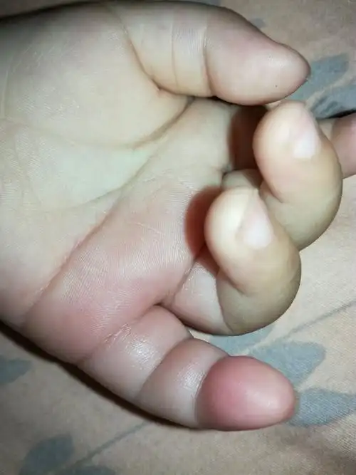 宝宝手指又肿又硬