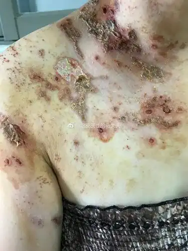 了解一下疱疹 - 好大夫在线