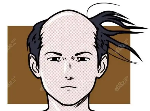 我变秃了,也变强了