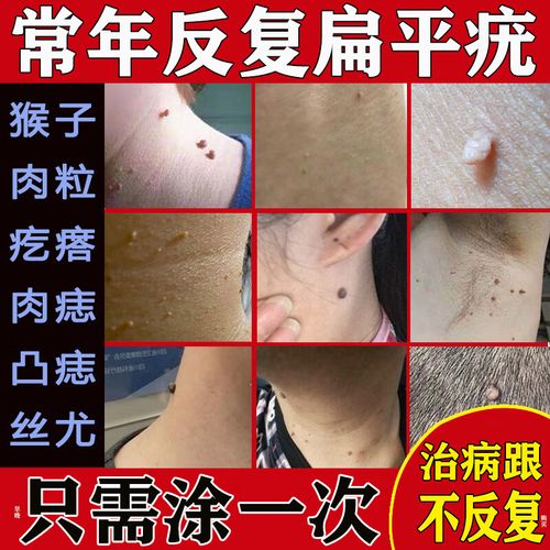 去猴子面部瘊子除小肉粒疙瘩猴子去除丝状疣跖疣祛疣膏一抹灵皮肤用药