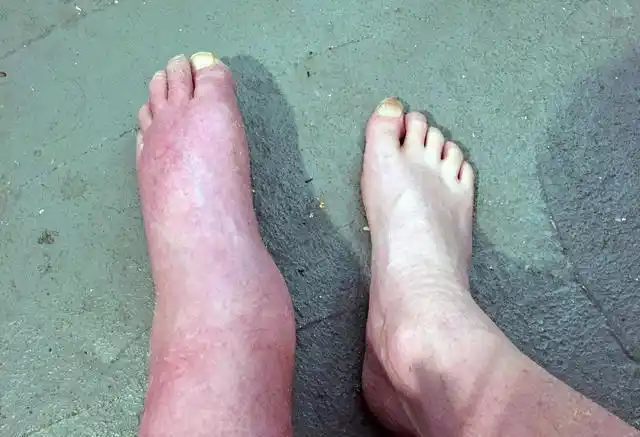 尿毒症有迹可寻一个人患上尿毒症到底有没有明显表现